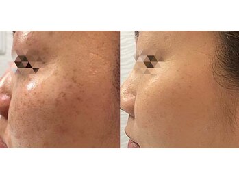 アティロン(Attirant)/【パーツごとに徹底シミ改善】