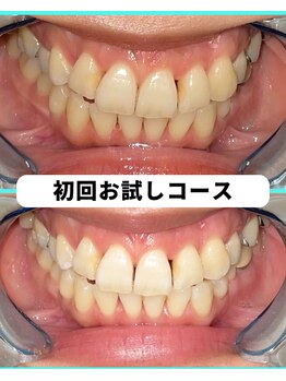 ホワイトニングビューティー 吉祥寺店/ホワイトニング 初来店