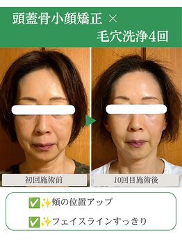 ブプラ 代々木上原店(BUPURA)/小顔×たるみ改善