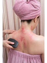 ロゼッタビューティー(Rosetta Beauty)/カッサで表れる赤みは消えます