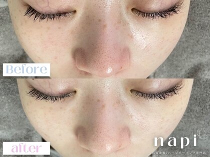 ナピ(napi)の写真