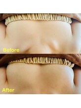 ベルージュ(Bellege)/ボンボンバストBefore after