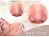 【埋毛/毛穴詰まりを改善したい方必見!!】 顔脱毛+毛穴洗浄¥15400→
