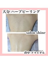 サロンシャイン(Salon Shine)/ハーブピーリング1回