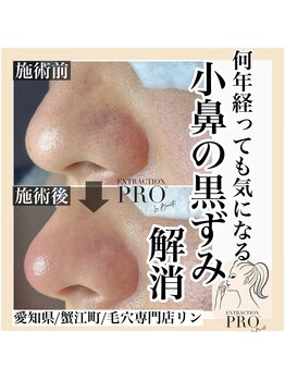 リン(Rin)/毛穴エクストラクションプロ