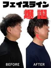 ララナ バイ カノア(LALANA by kanoa)/脂肪分解液導入でお顔の脂肪撃退
