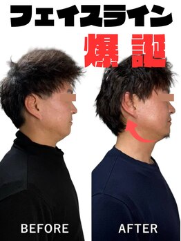 ララナ バイ カノア(LALANA by kanoa)/脂肪分解液導入でお顔の脂肪撃退