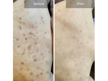 エミルカ 千葉店(EMILUCA)/ハーブピーリング背中/ニキビ