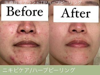 オーエン 小倉店(o-eN)/ニキビケア/ハーブピーリング