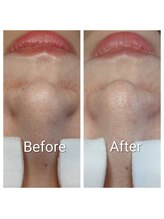 ポアレスサロン フィル(fil)/アルティメイトトリートメント後