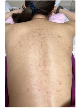 スキンケアスタジオ アコ 新宿店(Aco)/背中ニキビ/跡　グリーンピール