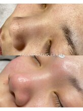 ゴールド 栄店(GOLD)/毛穴改善コース ５回後