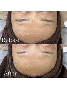 ラ フルール(La Fleur)/無針水光ジェット エアバリ