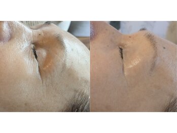 イロドリ(irodori)/しわ&たるみケア♪若々しい肌へ