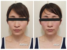 ヨサパーク ジジ(YOSA PARK ZiZi)/ルルオンでリフトアップ