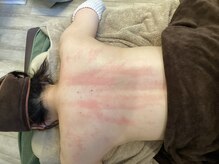 サクランボ(SAKURAMBO)/カッサ　血行促進に効果的◎