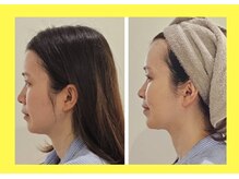 アン 銀座(ann)/レモンボトル小顔