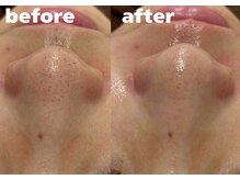 ホワイトラボ 堺東(White labo)/【20代女性 施術1回の効果】