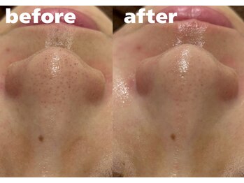 ホワイトラボ 堺東(White labo)/【20代女性 施術1回の効果】