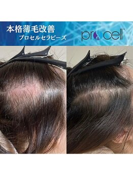 ベリー(Berry)の写真/最先端技術プロセルセラピーズで頭皮環境/肌質改善