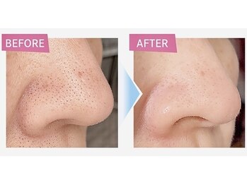 フィズ 新宿店(FIS)/☆毛穴洗浄☆［新宿三丁目］