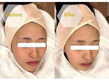 エピシア(EPICIA)/ハーブ★ビフォーアフター