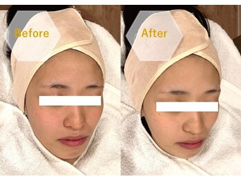 エピシア(EPICIA)/ハーブ★ビフォーアフター