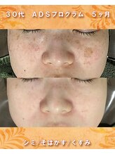 ナイア(naia)/リセラADS使用症例