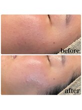 ディオーネ 春日井勝川店(Dione)/顔脱毛＋毛穴洗浄