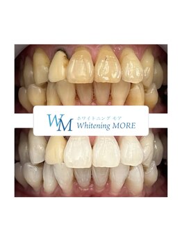 ホワイトニング モア(Whitening MORE)/ビフォーアフター