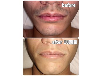 ノノケケ(NONOKEKE)/【メンズ脱毛】　ひげ脱毛