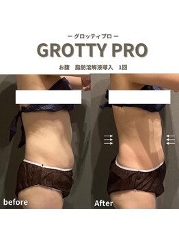 フルアナ(Hu ruana)/痩身/ダイエット/筋膜リリース