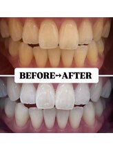ホワイトニングサロン 豊中/Before&After美白ホワイトニング