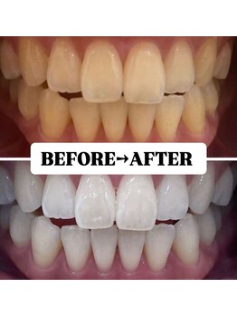 ホワイトニングサロン 豊中/Before&After美白ホワイトニング