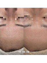 フロラスキン 恵比寿Leclat店(florasKIN)/肌質改善