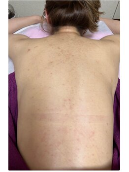 スキンケアスタジオ アコ 新宿店(Aco)/背中ニキビ/跡グリーンピール2回