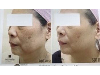 エステピーチ(Peach)/ヒト幹細胞培養上清液導入の結果