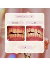 プラスビーセルフ(+b self)/ホワイトニングビフォーアフター