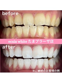 エクシアホワイトニング たまプラーザ店/ビフォーアフター