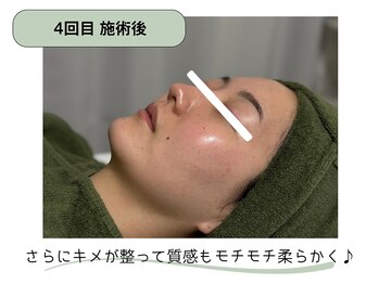 エヌ(Na.)/回数:4回(6週間に1回)