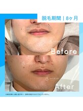 メンズクリア 藤沢OPA店/【メンズクリア】お客様の施術例