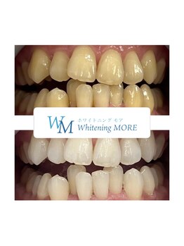 ホワイトニング モア(Whitening MORE)/ビフォーアフター