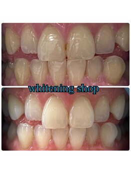 ホワイトニングショップ 三田店/before after