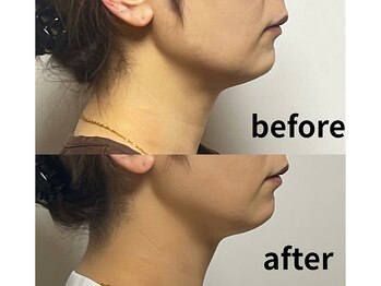 耀 カガヤキ/フェイスラインやエラをすっきり