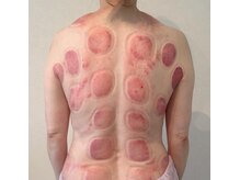 ビレイ(Birei)/カッサ＋カッピング