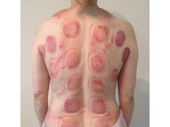 ビレイ(Birei)/カッサ＋カッピング