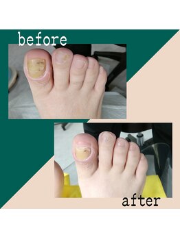 【肥厚・変形爪】ネイル/フット