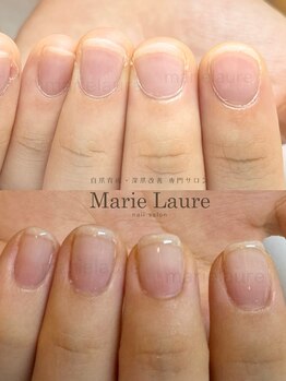 マリーロール 梅田店(Marie Laure)/深爪矯正/自爪育成/自爪風
