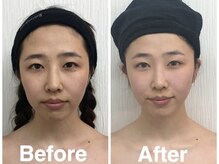 小顔フェイスラボ 四日市店(小顔FaceLabo.)/◆小顔コルギ Before→After◆