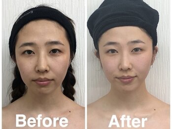 小顔フェイスラボ 四日市店(小顔FaceLabo.)/◆小顔コルギ Before→After◆